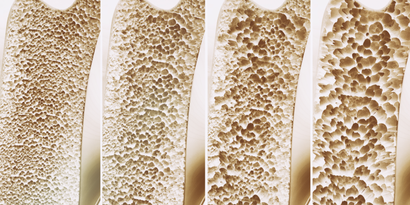 osteoporosis